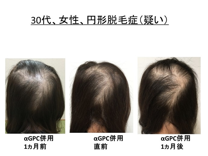 円形脱毛症　病院